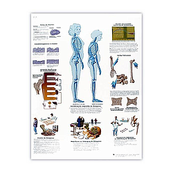 Osteoporosis - Lámina Anatomía