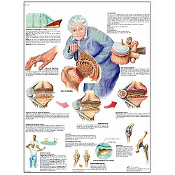 Artrosis - Lámina Anatomía