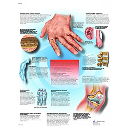 Enfermedades Reumáticas - Lámina Anatomía