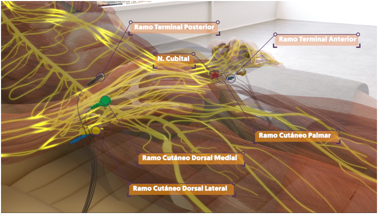Aplicación electrodos Nesa Neuromodulación No Invasiva en muñeca
