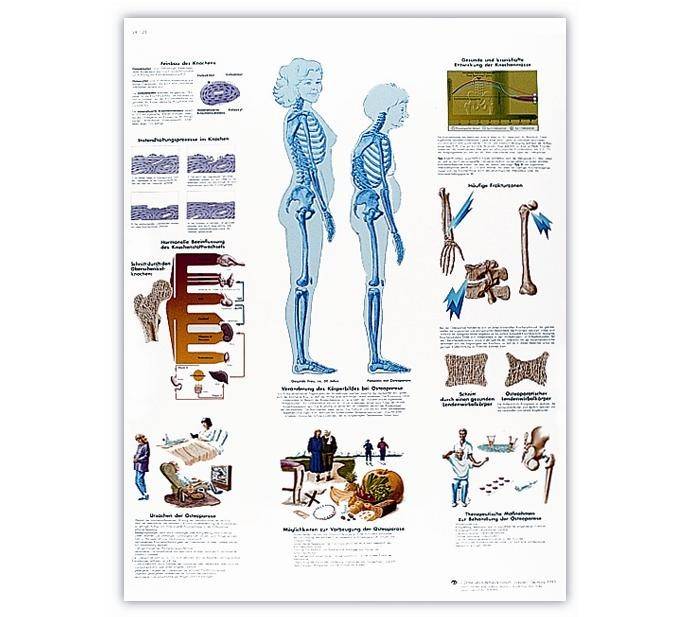 Osteoporosis - Lámina Anatomía