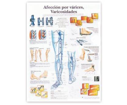 Afección Por Varices: Varicosidades - Lámina Anatomía