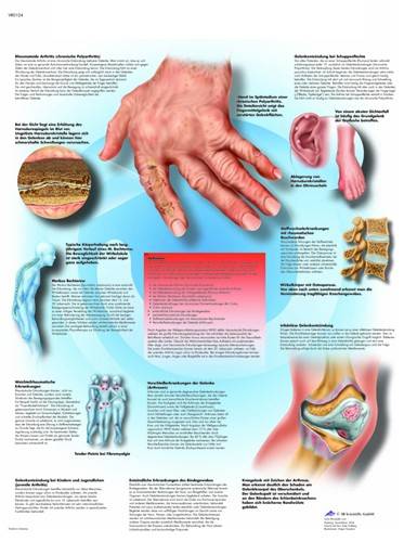 Enfermedades Reumáticas - Lámina Anatomía